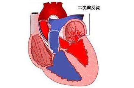 二尖瓣關(guān)閉不全