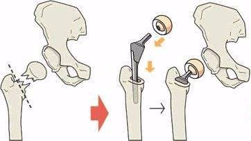 人工關(guān)節(jié)置換術(shù)