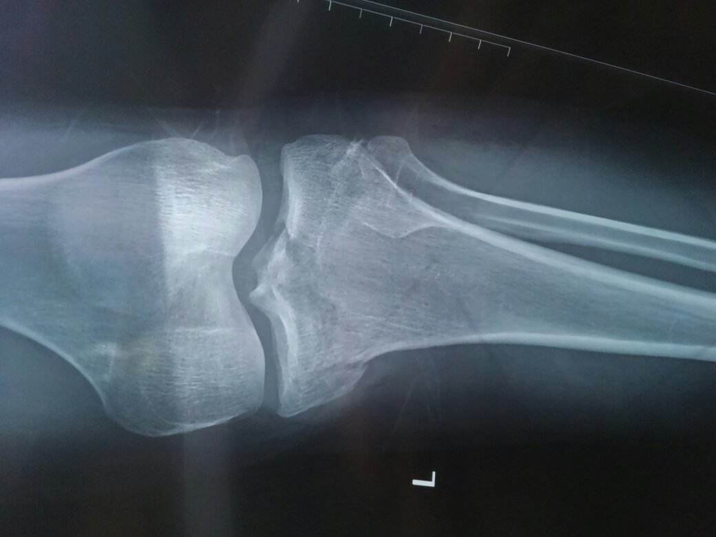 脛骨結(jié)節(jié)骨軟骨病