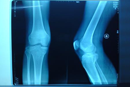 脛骨平臺(tái)骨折