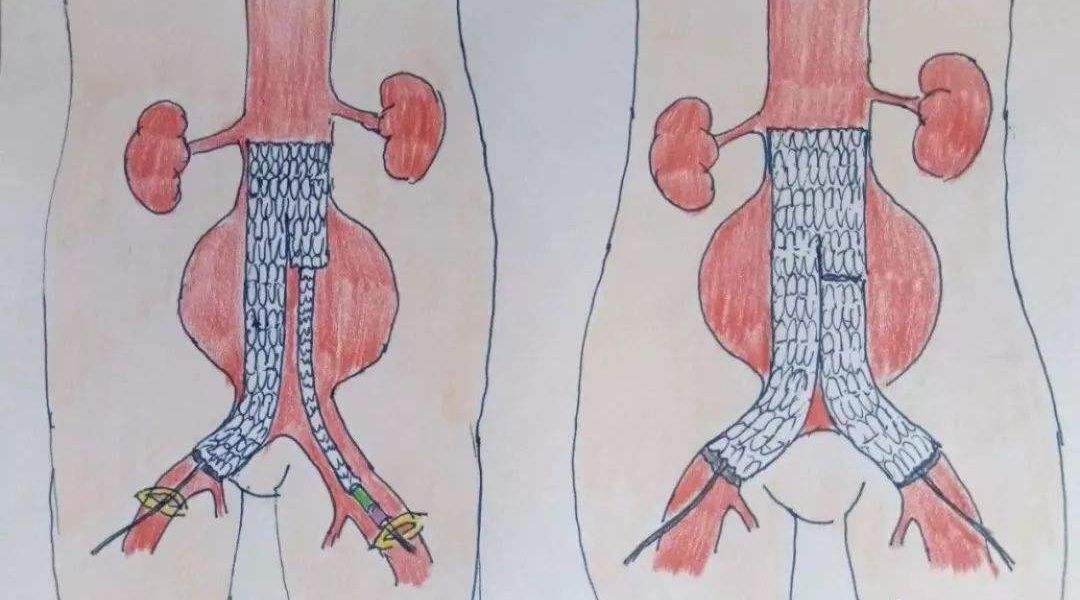 腹主動(dòng)脈瘤