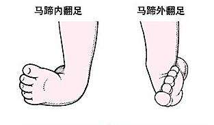 先天性馬蹄內(nèi)翻足
