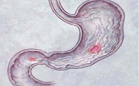 先天性十二指腸閉鎖