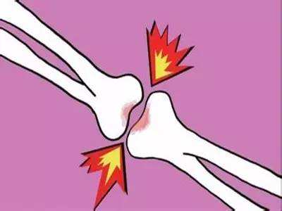 化膿性關(guān)節(jié)炎