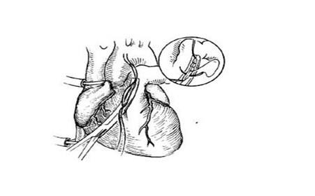 大動(dòng)脈錯(cuò)位