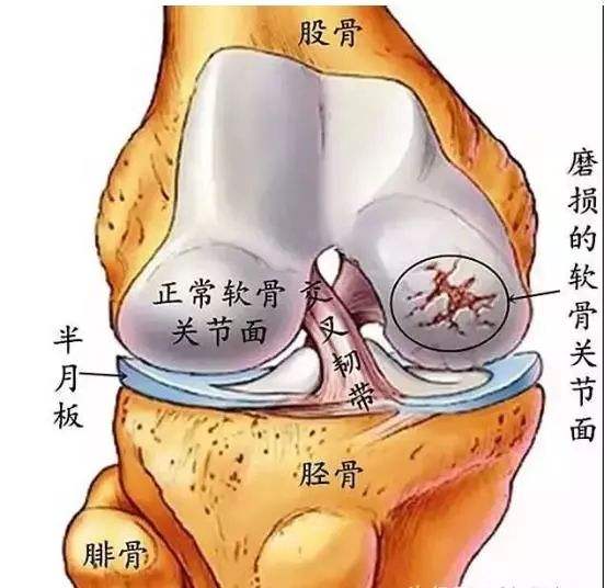 創(chuàng)傷性關(guān)節(jié)炎