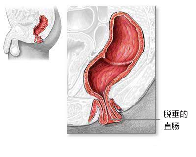 直腸脫垂