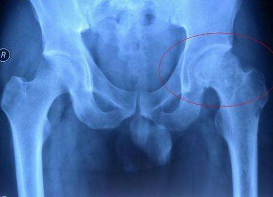 成人先天性髖關(guān)節(jié)脫位