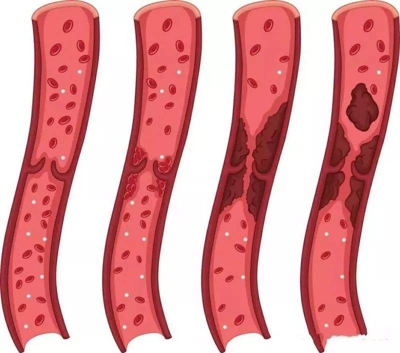 深靜脈血栓形成