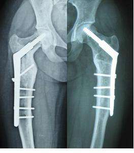 骨纖維結(jié)構(gòu)不良