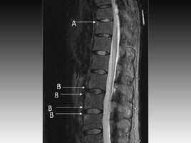 未分化脊柱關(guān)節(jié)病