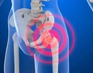 髖關(guān)節(jié)炎