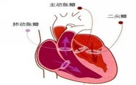 先天性二尖瓣關(guān)閉不全