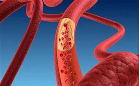 動脈硬化閉塞癥