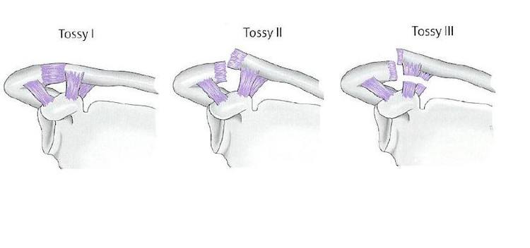 肩鎖關(guān)節(jié)脫位