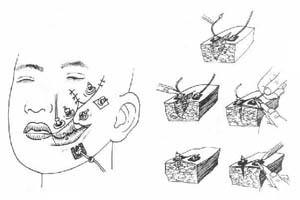 口腔頜面部囊腫