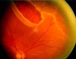 視網(wǎng)膜裂孔