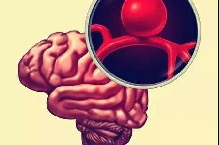 周圍動(dòng)脈瘤