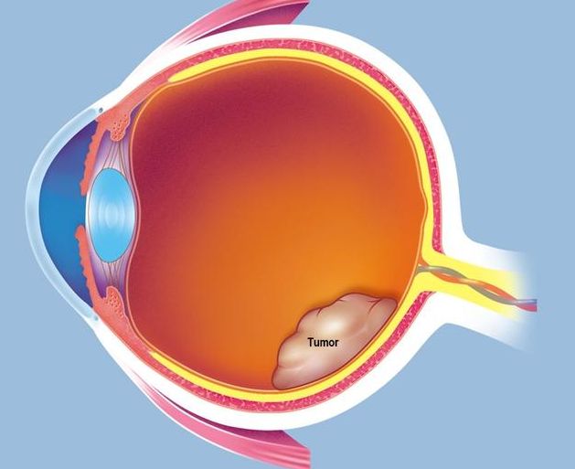 視網(wǎng)膜母細(xì)胞瘤