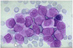 淋巴細(xì)胞白血病