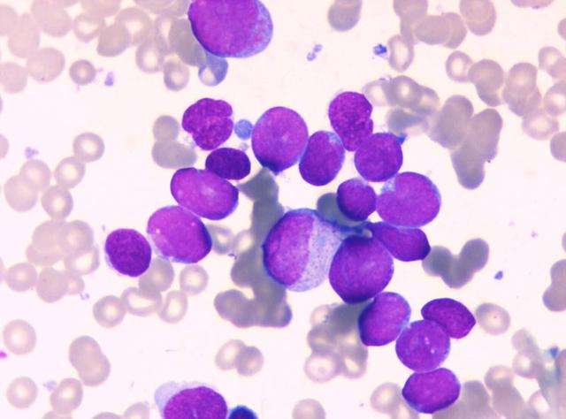 急性淋巴細(xì)胞白血病