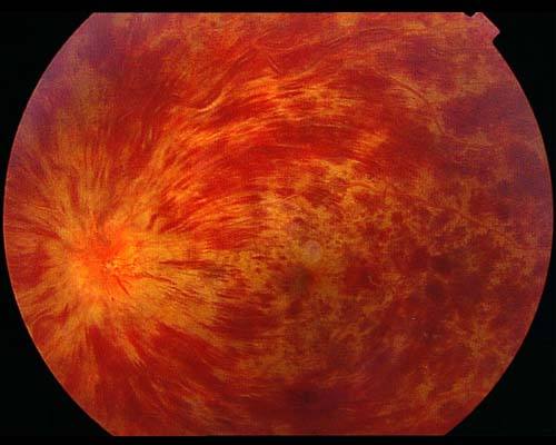 視網(wǎng)膜靜脈阻塞