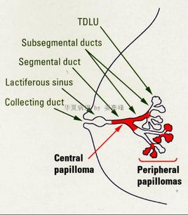 乳腺導(dǎo)管內(nèi)乳頭狀癌