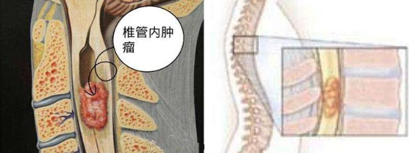 椎管內(nèi)腫瘤