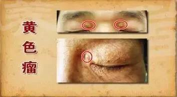 皮膚黃色瘤病