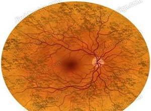 視網(wǎng)膜血管炎