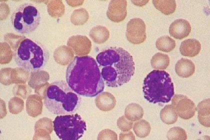 急性早幼粒細胞白血病