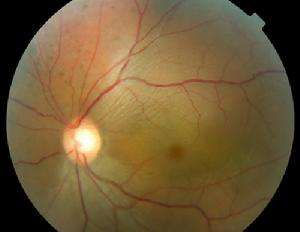 脈絡(luò)膜血管瘤