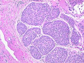 乳腺導(dǎo)管癌