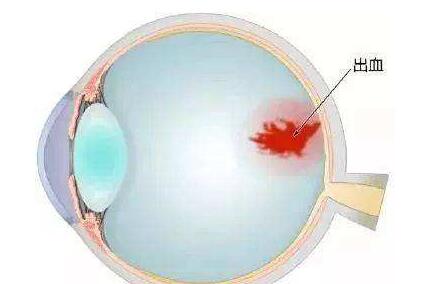 眼結(jié)膜下出血