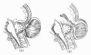 鼻部腦膜腦膨出