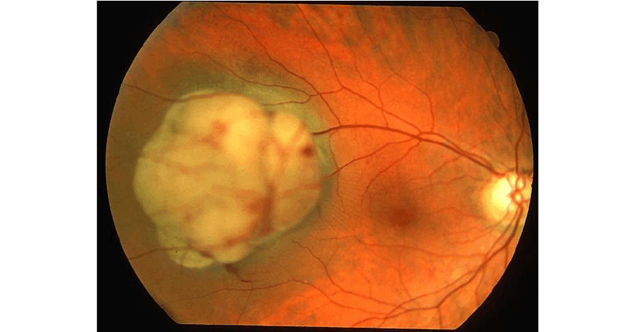 脈絡膜惡性黑色素瘤