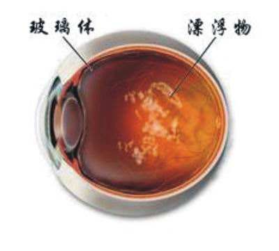 永存原始玻璃體增生癥