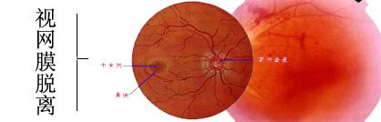 視網(wǎng)膜病