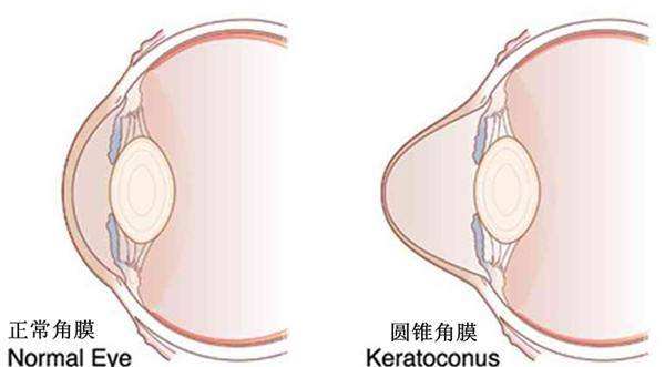 圓錐角膜