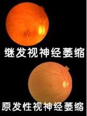 視神經(jīng)萎縮