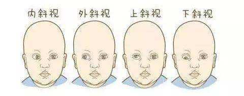 共同性內(nèi)斜視