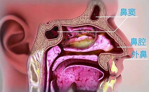 鼻腔及鼻竇異物
