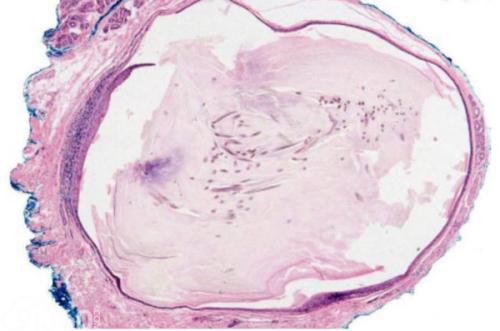 口腔皮樣或表皮樣囊腫