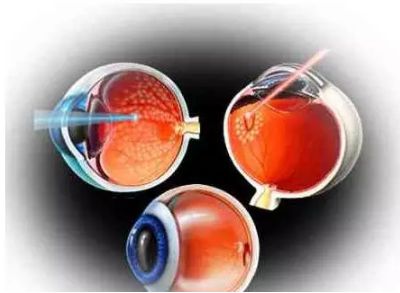 結(jié)膜色素痣