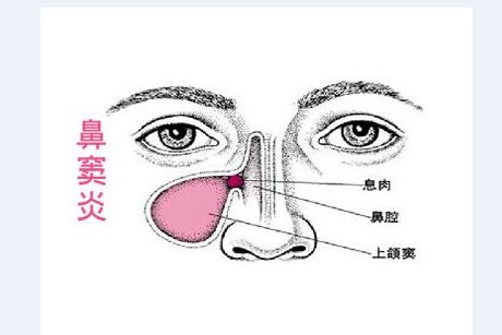 鼻竇炎