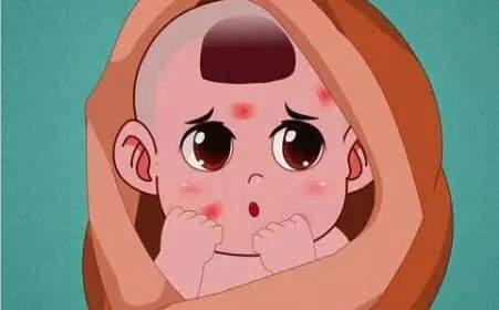 結(jié)節(jié)性紅斑