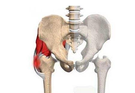 小兒股骨頭壞死