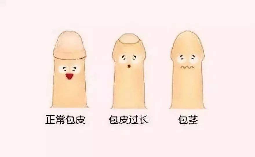 包皮過(guò)長(zhǎng)