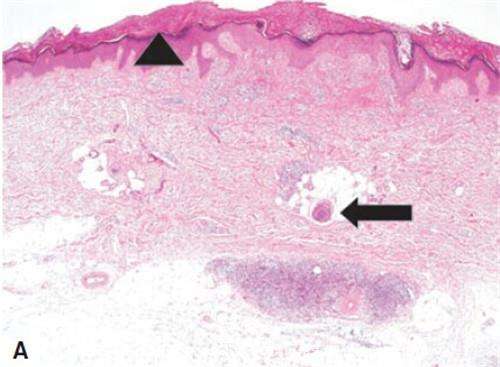 結節(jié)性癢疹