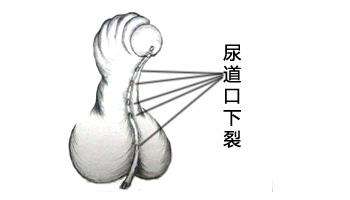 小兒尿道下裂